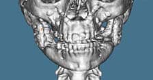 TMJ Custom Joint Replacement