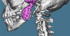 TMJ Custom Joint Replacement