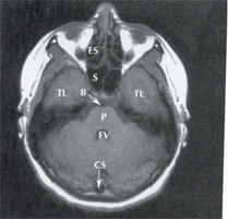 Computer tomography