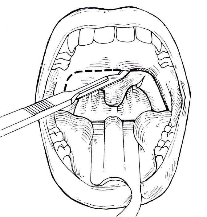 UPPP/LAUP procedure to treat sleep apnea in Ft. Lauderdale FL.