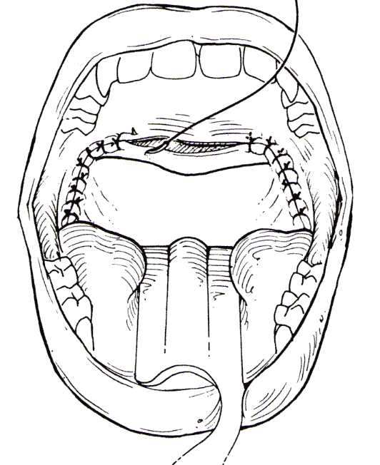 UPPP/LAUP procedure to treat sleep apnea in Ft. Lauderdale FL.