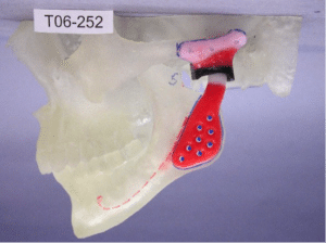 Patient Specific Total Joint Replacement