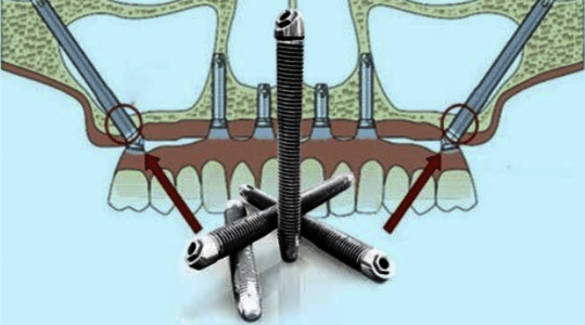 Dental Implant South Florida