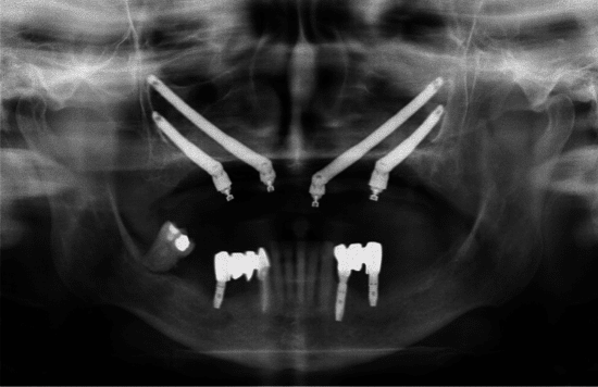 Implant Xray South Florida