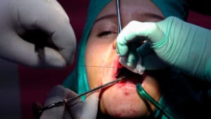 An image of a dentist stitching up a wound after surgery of oral cyst removal