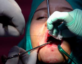 An image of a dentist stitching up a wound after surgery of oral cyst removal