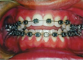 up close of teeth with braces with skeletal anchorage
