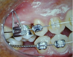 anchorage 3 to side of tooth with skeletal anchorage