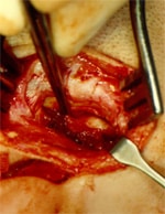 arthroplasty 1