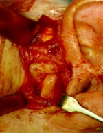 arthroplasty