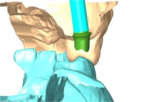 computer guided implant 2