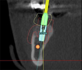 computer guided implant 6