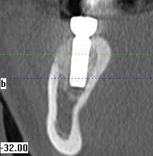 computer guided implant 7