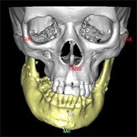3d simulation of skull with asymmetrical jaw highlighted yellow