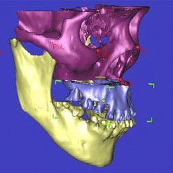 3d illustration of skull undergoing maxillary advancement, upper jaw being moved forwarded highlighted blue