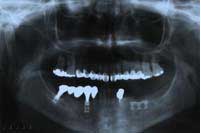 failing dentition 1