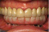 immediate denture 1