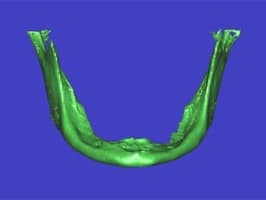 jaw bone resorption