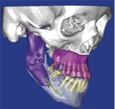 orthognathic 3