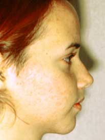 patient 2 profile after