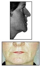 woman with soft tissue due to aging and bone loss