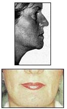 woman with soft tissue restored and profile enhanced after jaw reconstruction