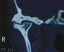 tmj arthritis
