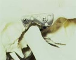 tmj partial replacement