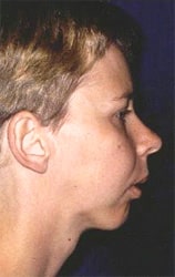 tmj surgery 1