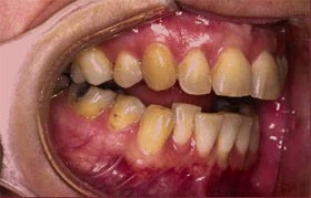 tmj surgery 2