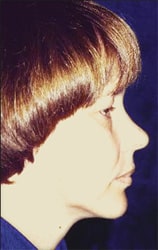 tmj surgery 3