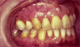 tmj surgery 4
