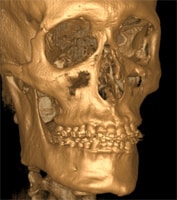 Cone Beam CT (CBCT) Fort Lauderdale FL