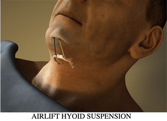 Airlift Hyoid Suspension