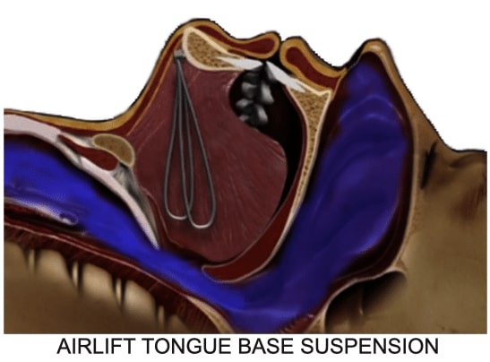 Airlift Tongue Base Suspension