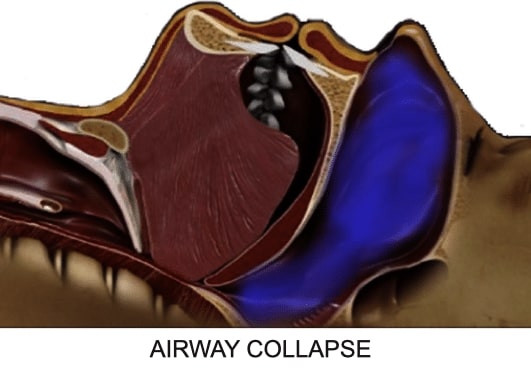 Airway Collapse
