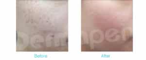 Dermapen ba
