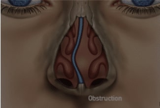 Deviated Septum 2