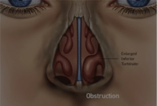 Enlarged Nasal Turbinates