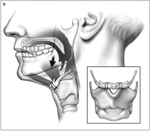 Traditional hyoid suspension