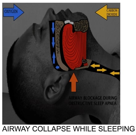 airwaycollapse