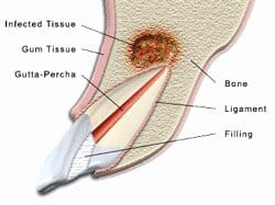 cross section illustration of infected tooth