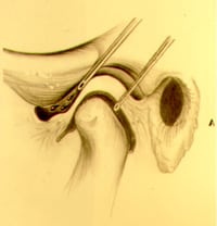 arthrocentesis