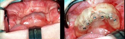 computer guided implant 5