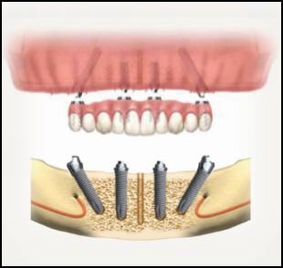 illustration of zaga zygoma upper jaw implant placement process