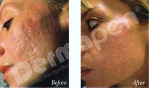 dermapen full face