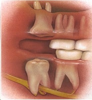 illustration of gum with impacted tooth
