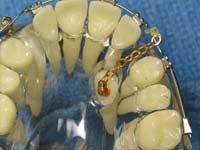 Impacted wisdom teeth Pompano Beach FL