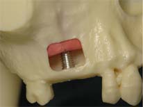 sinus lift dr. sultan 2