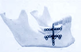 jawbone with metal distraction osteogenesis device